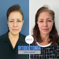Antes y después de Ritidectomía