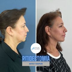 Antes y después de Ritidectomía