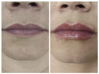 Aumento de labios - Dra. Karen Domínguez M