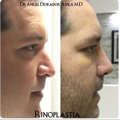 Antes y después de Rinoplastía 