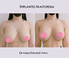 Antes y después de Mastopexia