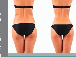 Antes y después de Lipoescultura