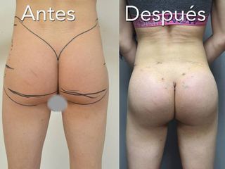 Antes y después de aumento de glúteos