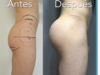 Antes y después de Aumento de glúteos