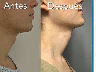 Antes y después de Reducción de hioides