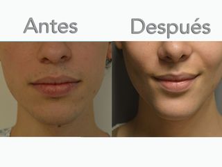 Antes y después de Mentoplastia