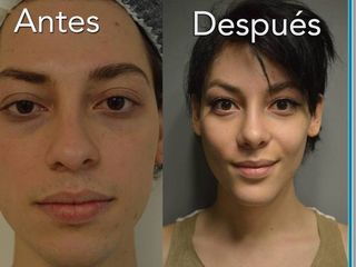 Antes y después de feminización facial