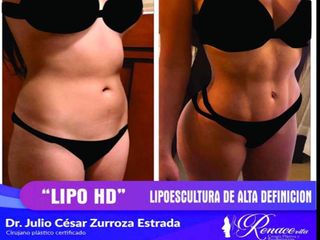 Lipo HD Dr Julio César Zurroza Estrada.