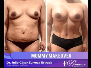 Mommy Makeover Dr Julio César Zurroza Estrada