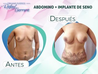 Antes y después de Lipoescultura - Dr. Rafael Barrera Vazquez