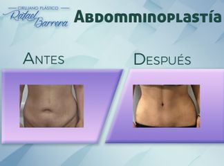 Antes y después de Abdominoplastia - Dr. Rafael Barrera Vazquez