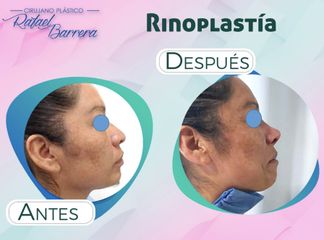 Antes y después de Rinoplastia - Dr. Rafael Barrera Vazquez