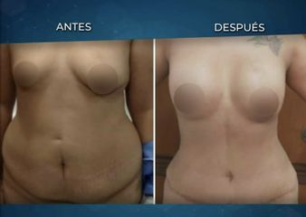 Antes y después de Abdominoplastia - Dr. Rafael Barrera Vazquez