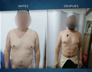 Antes y después de Abdominoplastia - Dr. Rafael Barrera Vazquez