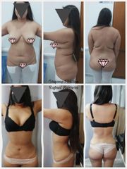 Antes y después de Abdominoplastia - Dr. Rafael Barrera Vazquez