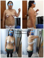 Antes y después de Liposucción - Dr. Rafael Barrera Vazquez