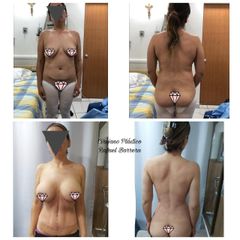 Antes y después de Abdominoplastia - Dr. Rafael Barrera Vazquez