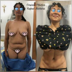 Antes y después de Abdominoplastia - Dr. Rafael Barrera Vazquez