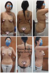 Antes y después de Abdominoplastia - Dr. Rafael Barrera Vazquez