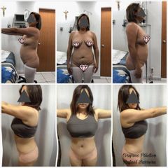 Antes y después de Abdominoplastia - Dr. Rafael Barrera Vazquez