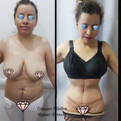 Antes y después de  Abdominoplastia - Dr. Rafael Barrera Vazquez