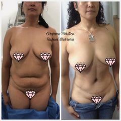 Antes y después de Abdominoplastia - Dr. Rafael Barrera Vazquez