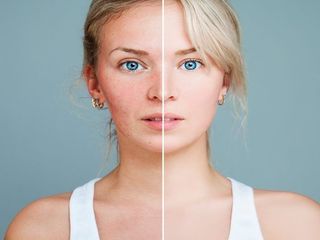 Antes y después de tratamiento facial 