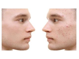 Antes y después de tratamiento Anti Acné