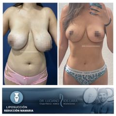 Reducción mamas - Dr. Luciano Ríos Lara