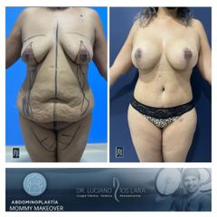 Lipoescultura - Dr. Luciano Ríos Lara