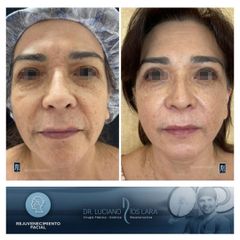 Rejuvenecimiento Facial - Dr. Luciano Ríos Lara