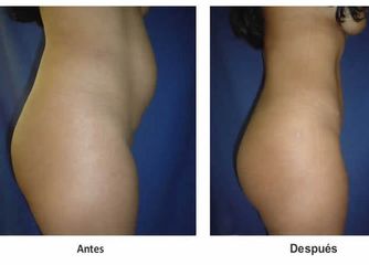 Antes y después de lipoescultura