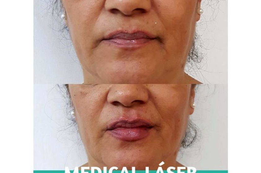 Aumento de labios antes y después - 639676