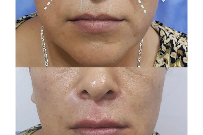 Toxina botulínica antes y después - 645912