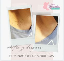 Eliminación de verrugas - Dra. Yesenia Figueroa Velasco