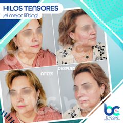 Hilos tensores - B+ Care
