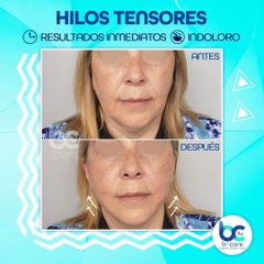 Hilos tensores - B+ Care
