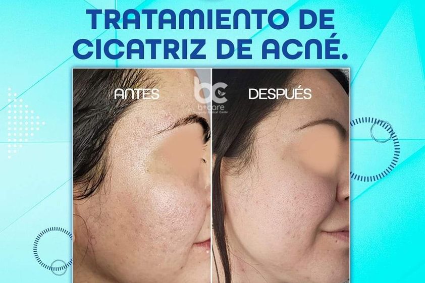 Tratamiento antiacné antes y después - 739443