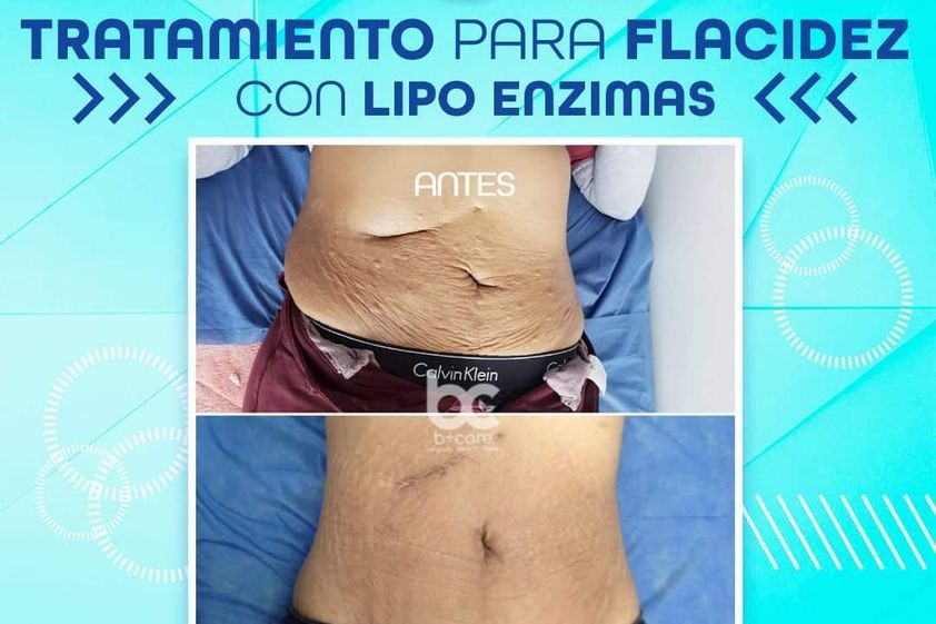 Lipólisis antes y después - 739445