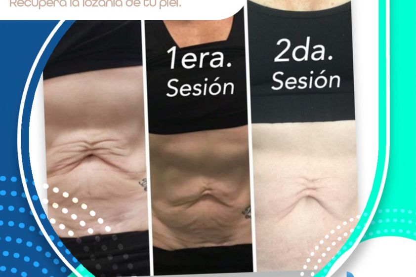 Radiofrecuencia antes y después - 798391