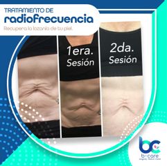 Radiofrecuencia - B+ Care. Dra.Lore Piña