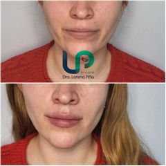 Aumento de labios - B+ Care. Dra.Lore Piña