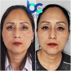 Tratamiento manchas  BCare Dra. Lorena Piña 