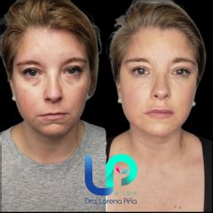 Rejuvenecimiento Facial - Dra. Lorena Piña