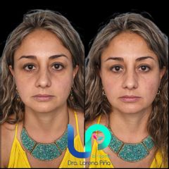 Relleno de ojera - Dra. Lorena Piña