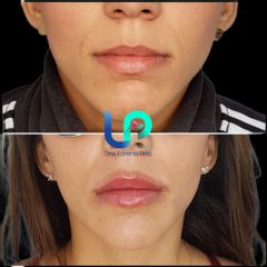 Aumento de labios - Dra. Lorena Piña