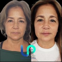 Rejuvenecimiento Facial - Dra. Lorena Piña