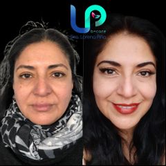 Rejuvenecimiento Facial - Dra. Lorena Piña