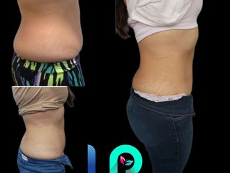 Lipólisis antes y después - 838852