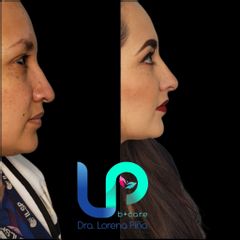 Rinomodelación  - Dra. Lorena Piña